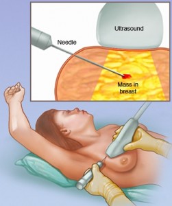 ultrasound-guided breast biopsy