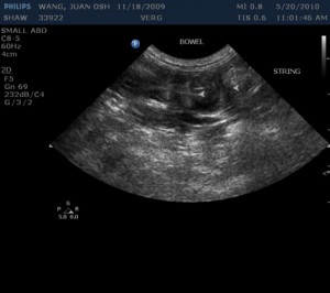 Abdominal-Ultrasound-Pic-2