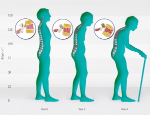Osteoporosis Stages