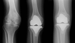 knee arthropathy