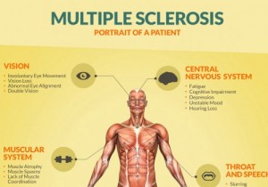 multiple+sclerosis