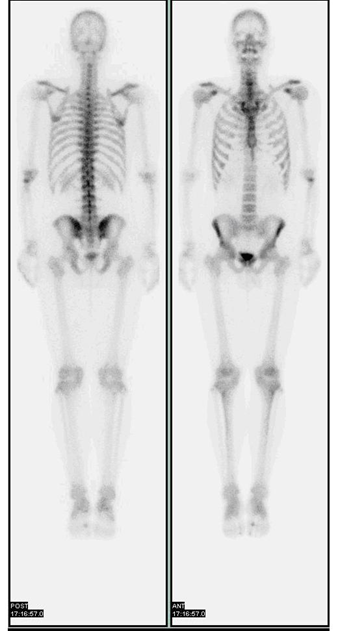 Bone Scan - What to Expect - Capitol Imaging Services