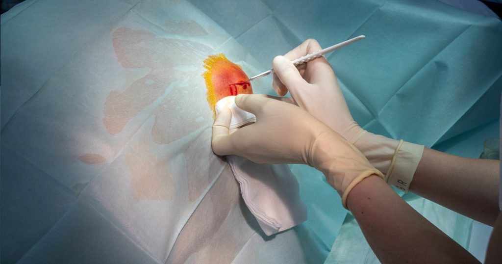 What Is Breast Cyst Aspiration Capitol Imaging Services