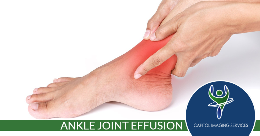 Ankle Joint Effusion