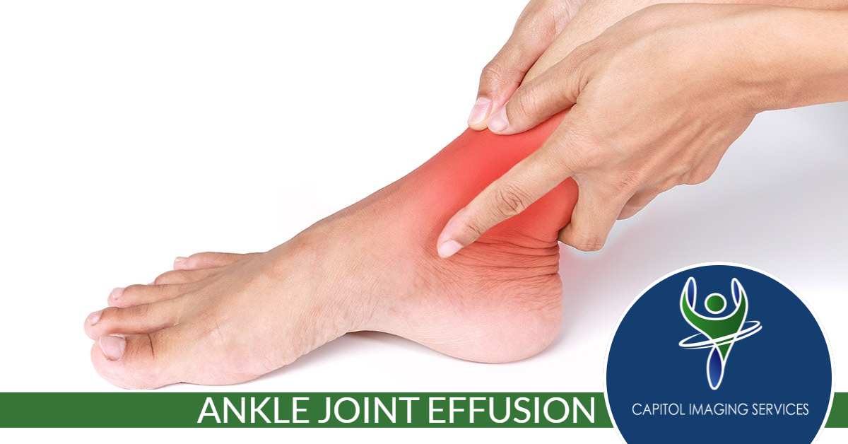 Ankle joint effusion - Capitol Imaging Services