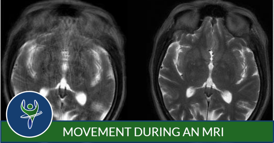 Movement During MRI