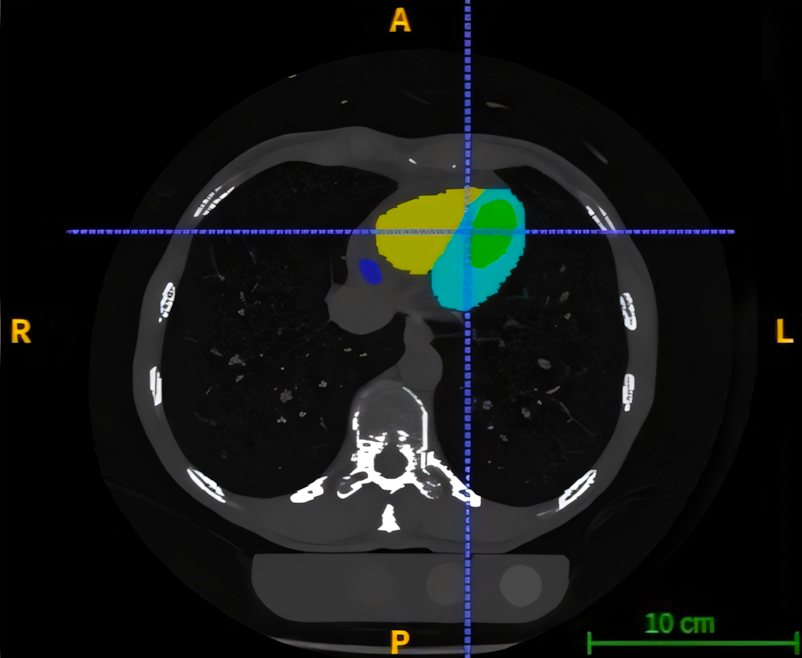 AI Heart Health Evaluation