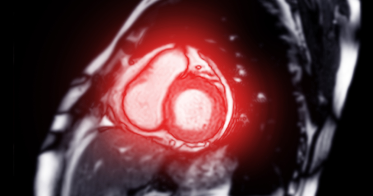 Cardiac MRI